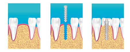 implant dentaire bondy