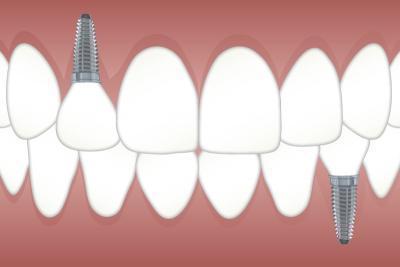 nettoyage implant dentaire Bondy